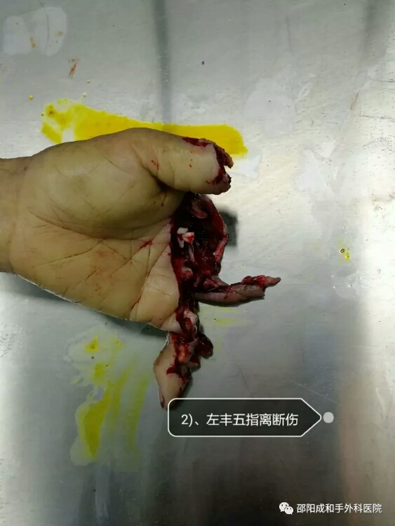 邵陽(yáng)創(chuàng)傷骨科,邵陽(yáng)風(fēng)濕病區(qū),邵陽(yáng)骨質(zhì)增生,邵陽(yáng)關(guān)節(jié)病區(qū),邵陽(yáng)頸椎病區(qū)